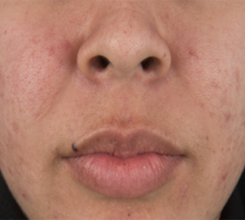 Acne-After