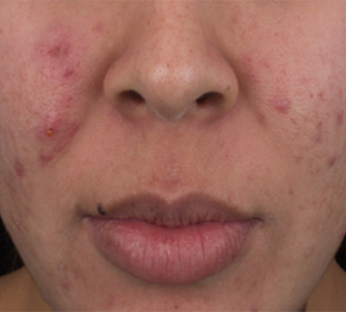 Acne-Before